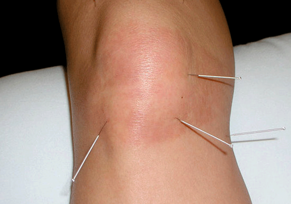 Is Acupuncture Painful?