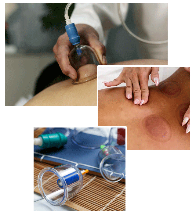 https://www.quantamphysiotherapy.com/assets/images/cupping-therapy-pic.png