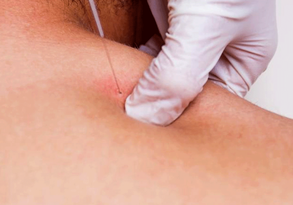Conditions For Dry Needling