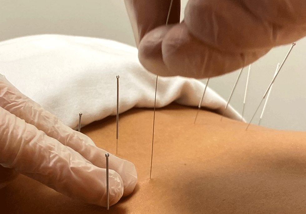 Professional Dry Needling Clinic in London, Ontario