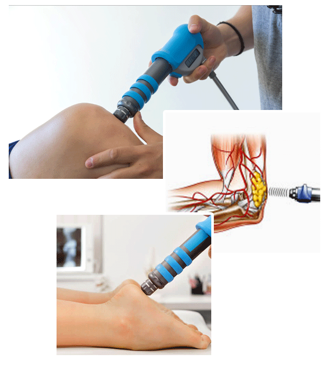 Shockwave Therapy